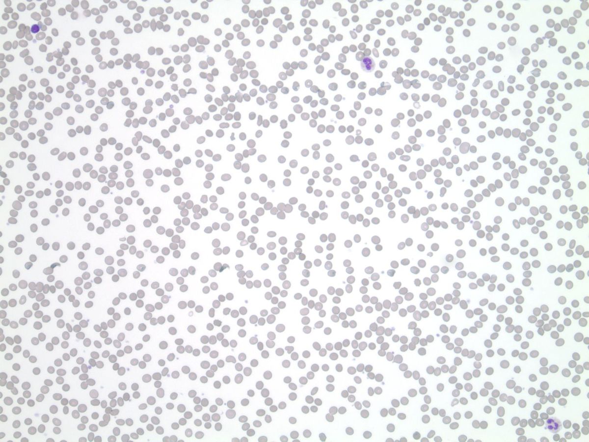 Peripheral blood smear showing rare unremarkable white blood cells